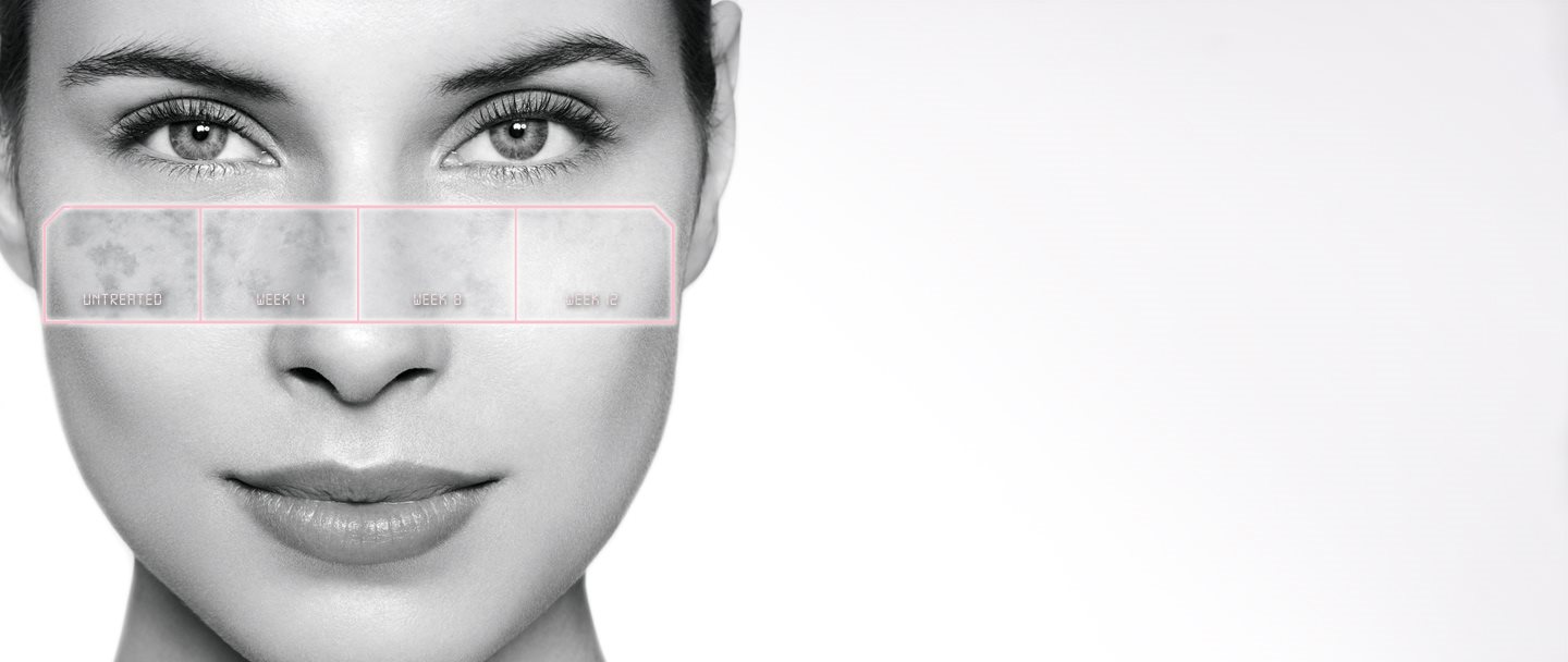 Développement d’une hyperpigmentation lors d