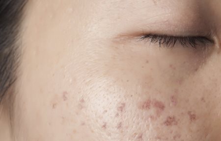 Visage d'une femme atteint de troubles de la pigmentation